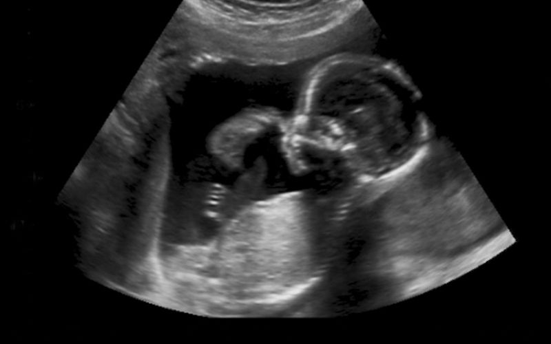 Siêu âm khảo sát dị tật hình thái là một mốc thăm khám quan trọng
