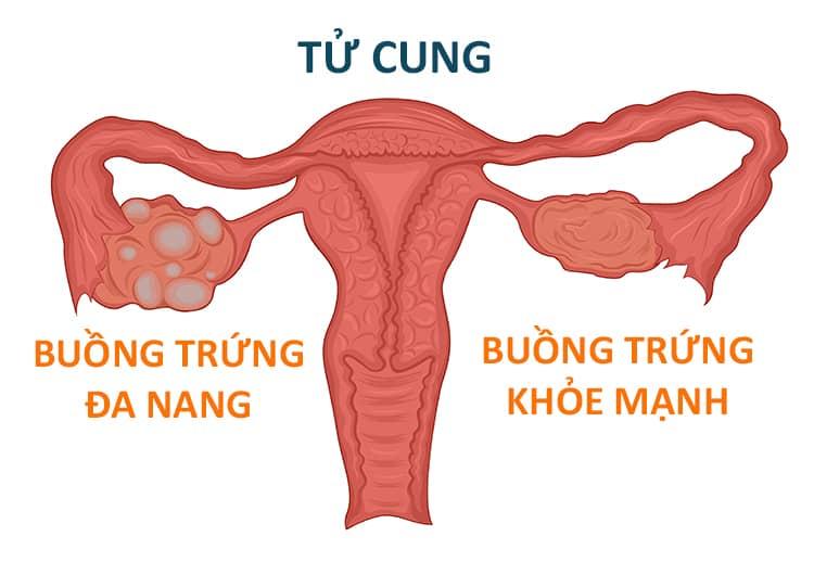 PCOS cần được hỗ trợ bằng Vitamin và hoạt chất chuyên biệt