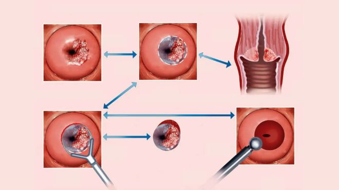 Dịch vụ được chỉ định để đánh giá hiệu quả điều trị sau các can thiệp cổ tử cung