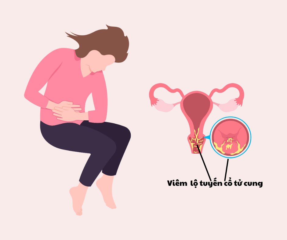 Viêm lộ tuyến cổ tử cung ảnh hưởng rất nhiều đến chất lượng cuộc sống 