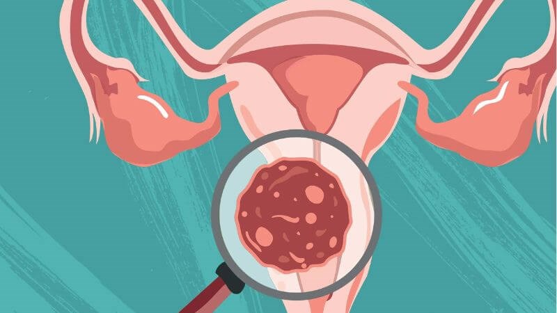 Viêm lộ tuyến cổ tử cung là tình trạng lộ tuyến cổ tử cung kèm theo viêm nhiễm