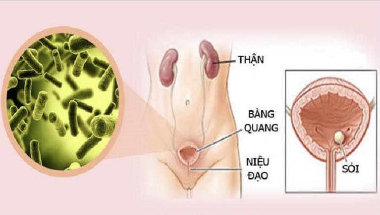 Nhiễm trùng đường tiết niệu trong thai kỳ thường do vi khuẩn E.coli gây ra