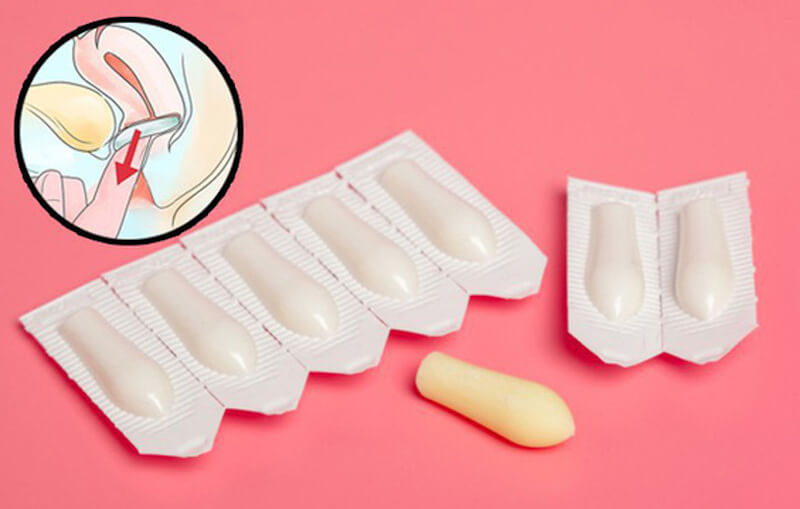 Sử dụng thuốc đặt âm đạo là 1 trong những cách điều trị viêm âm đạo do nấm