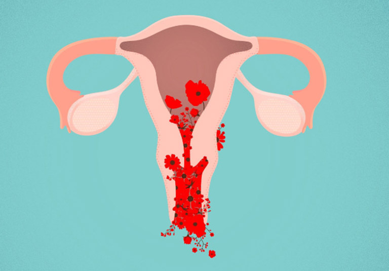 Xuất huyết tử cung bất thường có thể liên quan đến các bệnh lý ác tính